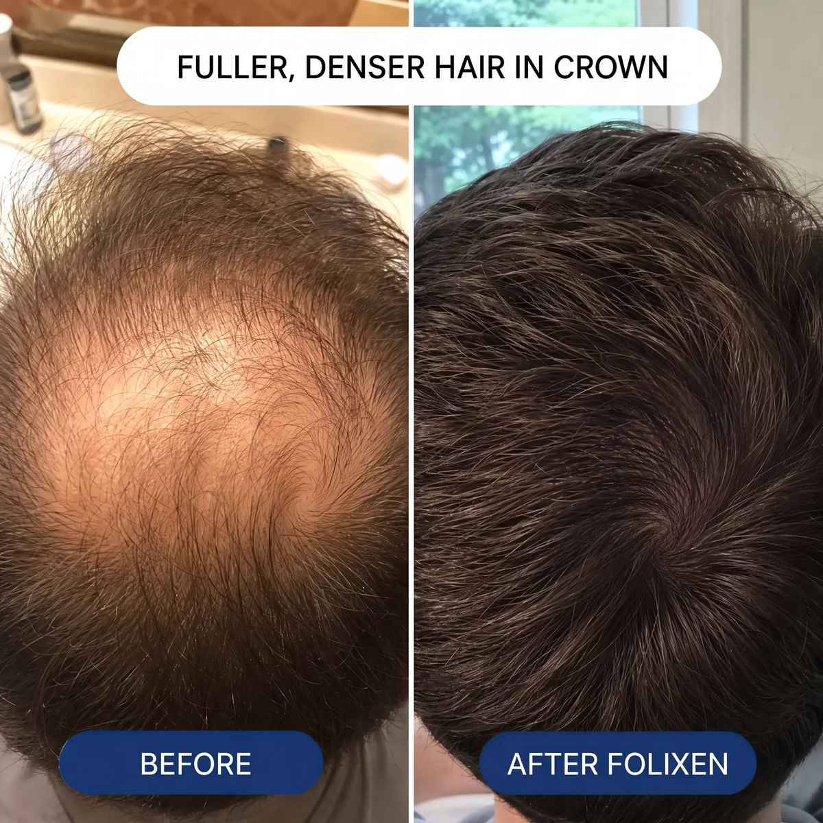 Folixen Hair Density Solution