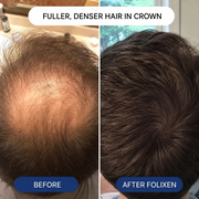 Folixen Hair Density Solution